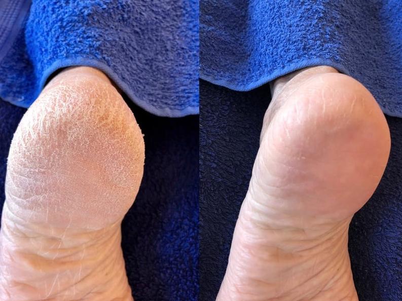 REMOVE ROUGH DRY SKIN AND CALLUSES IN UNDER 2 MINUTES Lovaskin